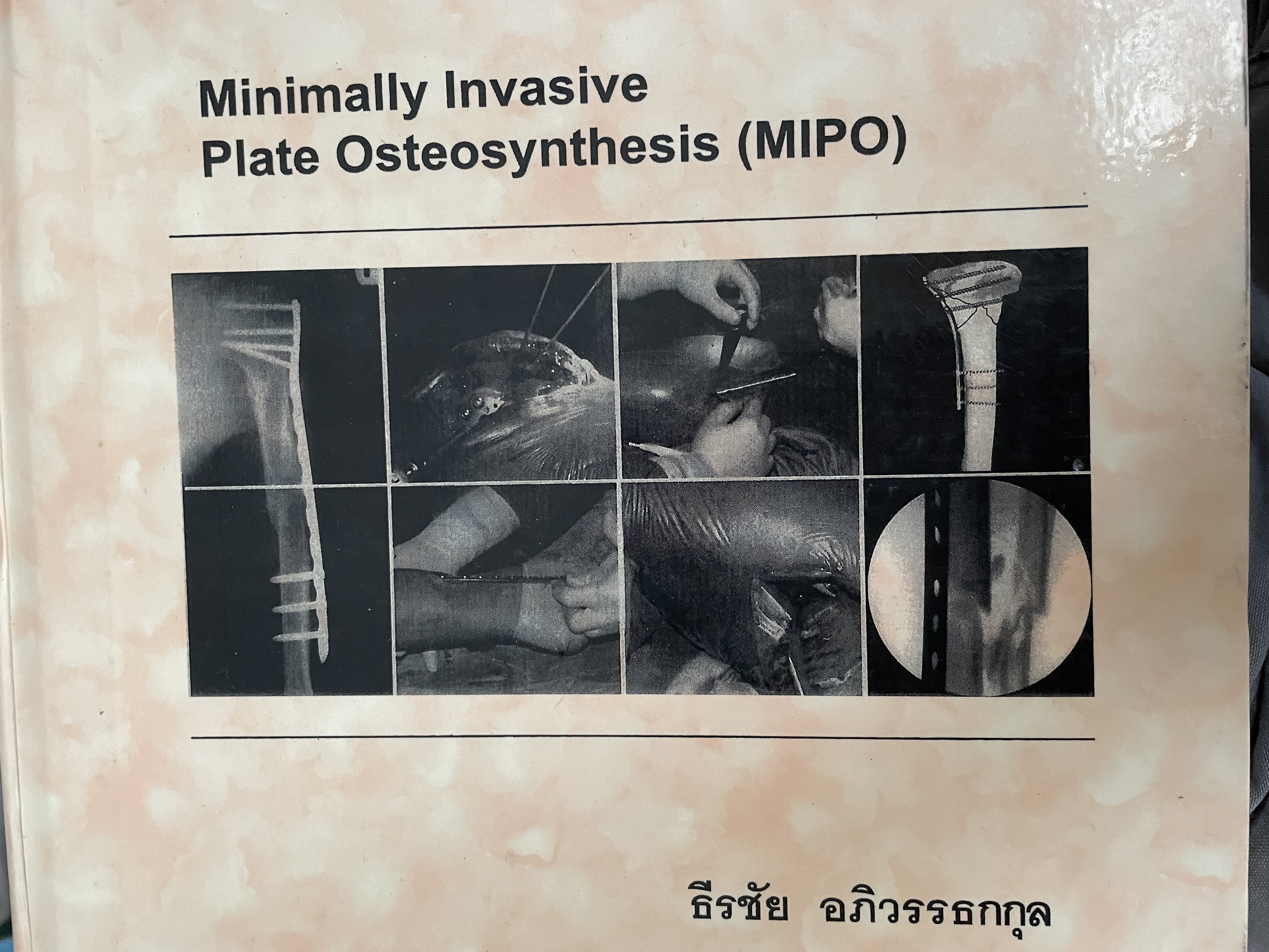 Minimally. Invasive Plate Osteosynthesis (MIPO). ผู้เขียน ธีรชัย อภิวรรณธกกุล 6,500 กรัม