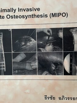 Minimally. Invasive Plate Osteosynthesis (MIPO). ผู้เขียน ธีรชัย อภิวรรณธกกุล 6,500 กรัม